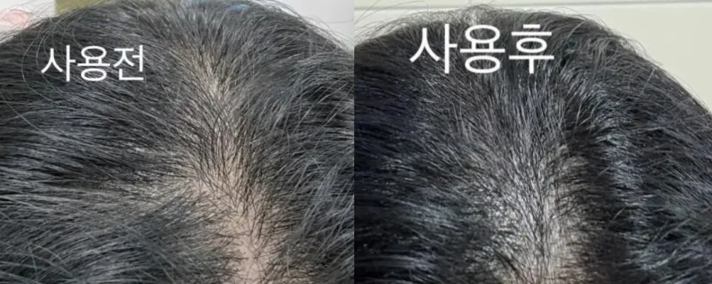 다자르 탈모앰플 후기